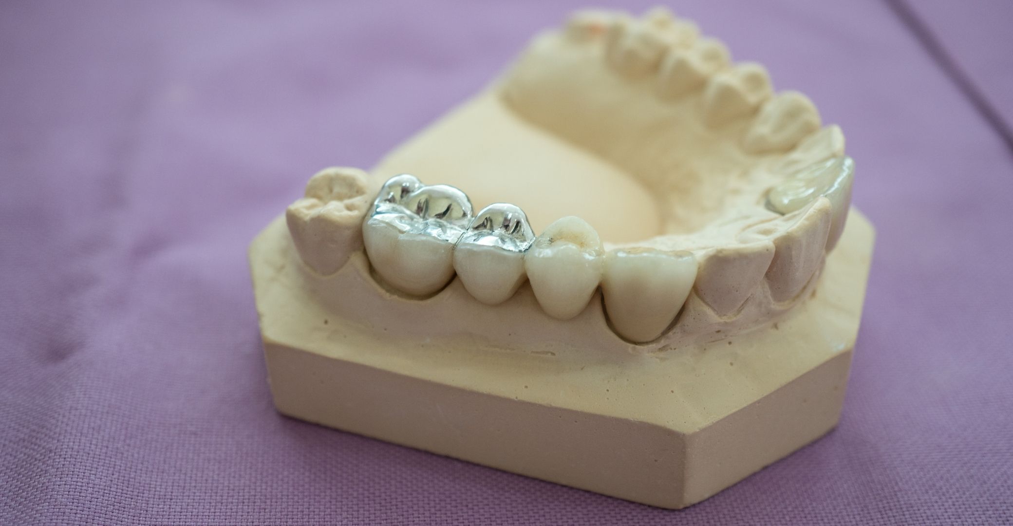 Denture with tooth amalgam filling